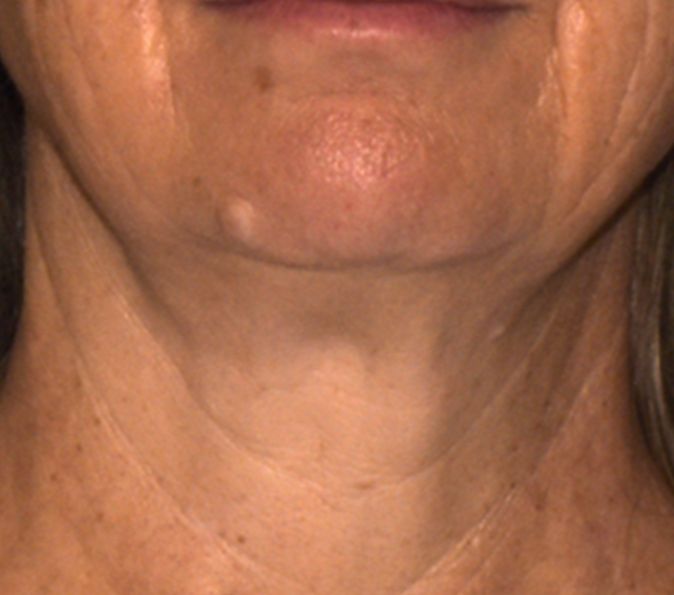 After image