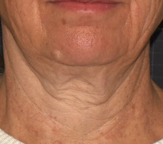 Before image